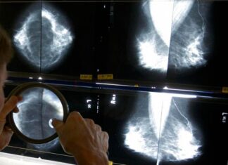 Tumore al seno, prevenire salva la vita. L’importanza dello screening mammografico